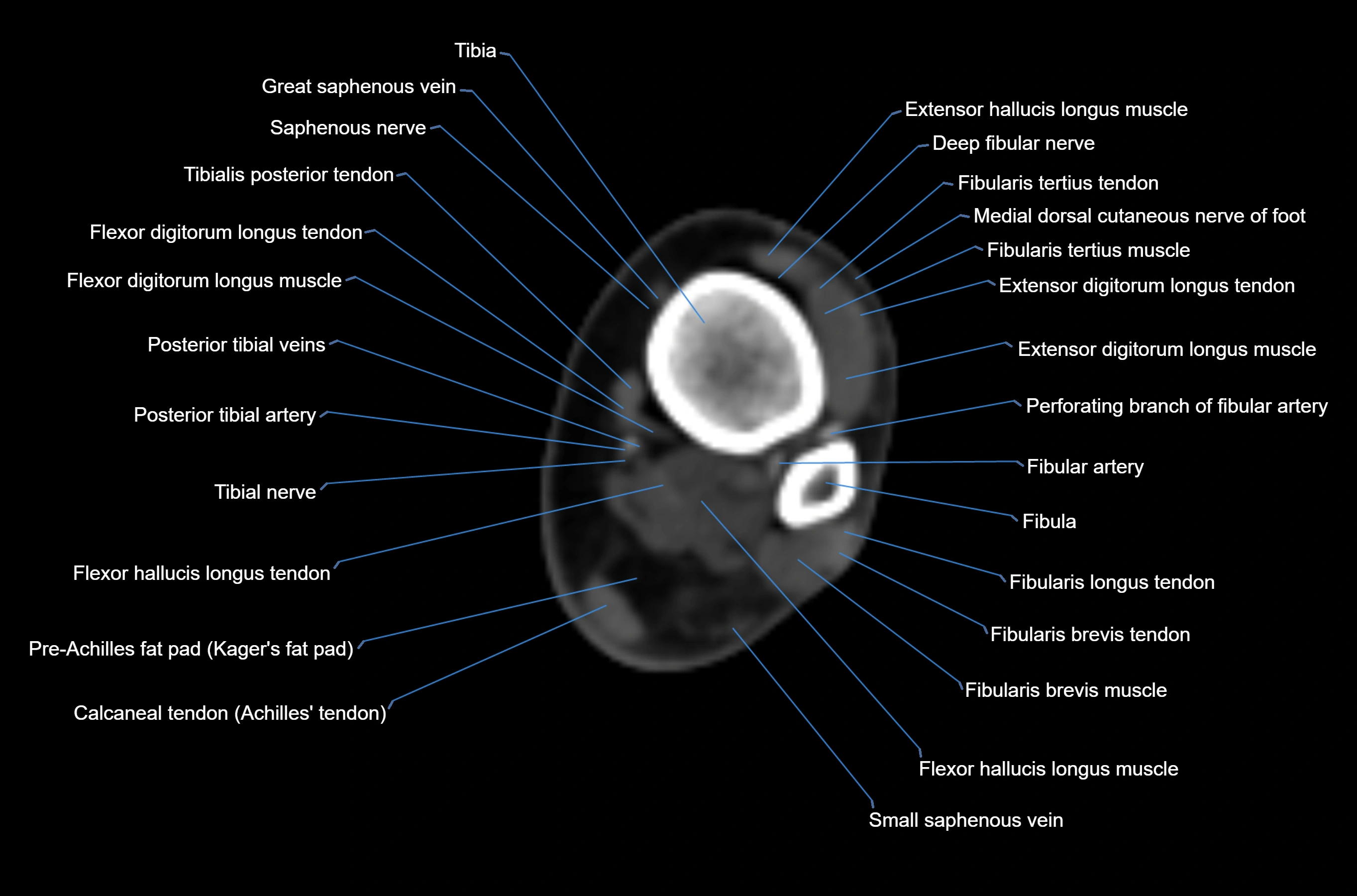 CT Ankle axial cross sectional anatomy labelled image -00019.webp